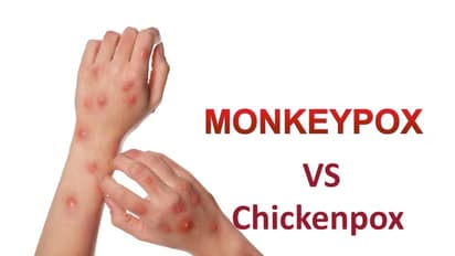 Monkeypox vs chickenpox