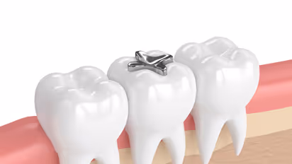 Countries Agree to End Mercury Use in Dentistry