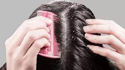 Dandruff