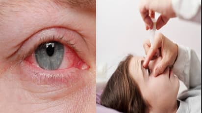 Conjunctivitis