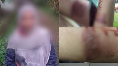 Complaint alleges teacher burned hand of disabled woman