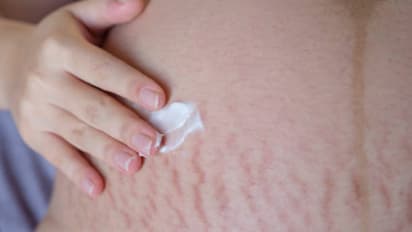 Stretch Marks