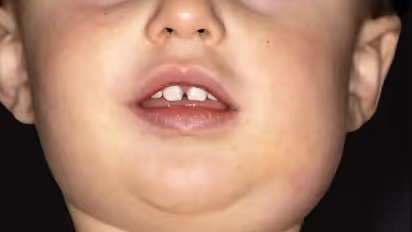 Mumps