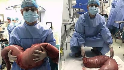 In California 30 pounds of stool accumulated in the stomach must be removed bsm