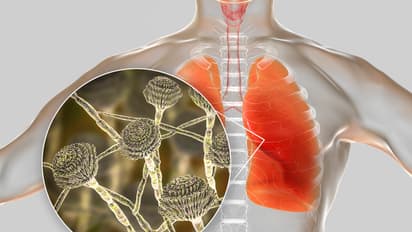 Aspergillus Fumigatus
