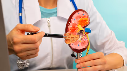 Kidney Stones and Treatment