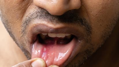 Mouth Ulcers