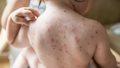 Chickenpox