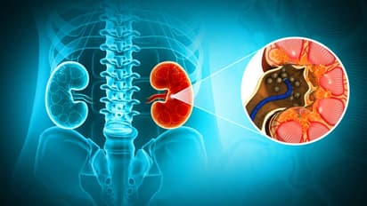 Kidney Stones and Treatment