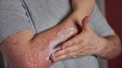 Eczema