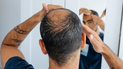Homeopathy remedies to stop hair fall and regrow hair, you can take 7 days challenge bsm