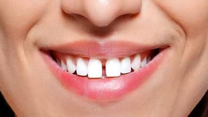 Meaning of gap teeth