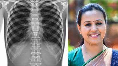 Spinal muscular atrophy