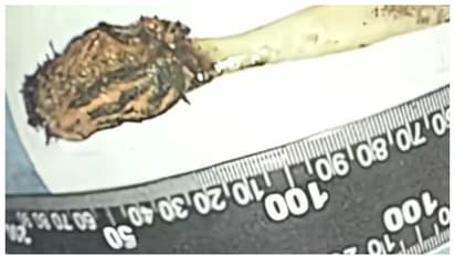 toothbrush swallowed at age of 12 was remove at age of 64 in surgery