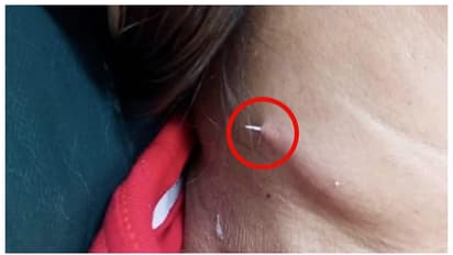 Fishbone stuck in woman's throat exits through her neck in thailand 