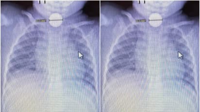 Toddler swallowed button battery 