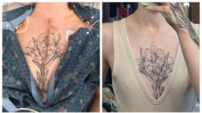 Open heart surgery image by anna