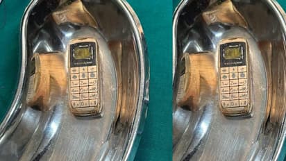 mobile phone removed from the stomach