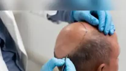 hair transplant