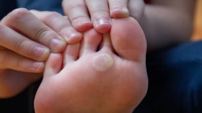 Effective Home Remedies for Calluses