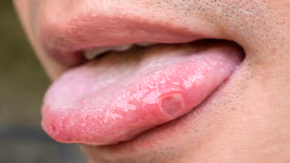 home remedies for tongue sores