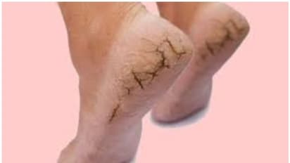 Cracked heels