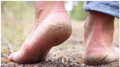 Cracked feet