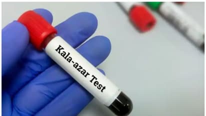 Kala Azar or Black fever