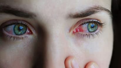 Conjunctivitis