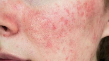 lupus