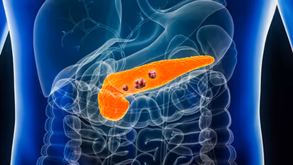 Pancreatic Cancer