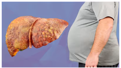 fatty liver 