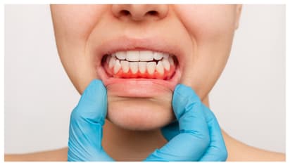 gum health