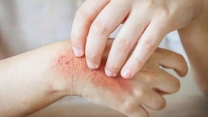 skin fungal infections