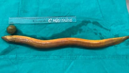 Man insert live eel into his anus