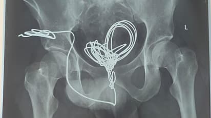 man inserted wire in urethra