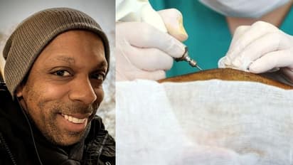 hair transplant death