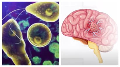 amoebic meningoencephalitis