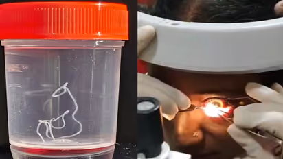 live worm extracted from womans eye