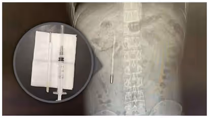 mercury thermometer swallowed