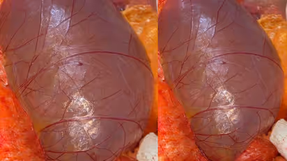 Colonic Mesentric Cyst