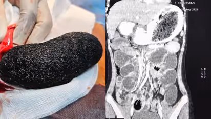 hairball-surgery