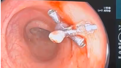 polypectomy via colonoscopy