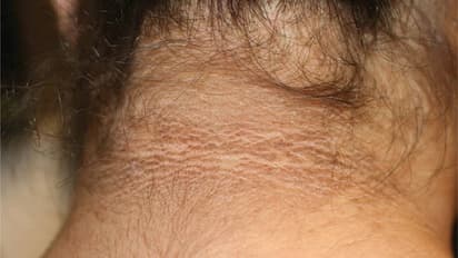 Neck Pigmentation