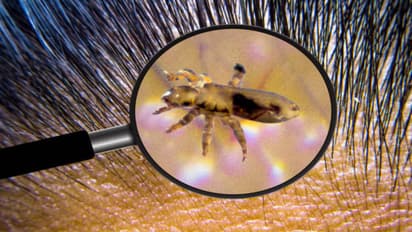 home remedies to get rid of lice and dandruff in one day