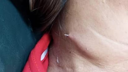 Fish bone pokes through woman's neck weeks after drinking soup