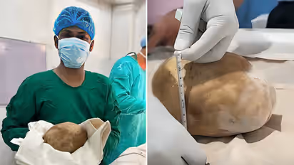 Sri Lanka doctors remove 3 1 kg bladder stone from 55 year old man