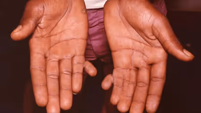 Is-having-6-fingers-lucky-or-unlucky