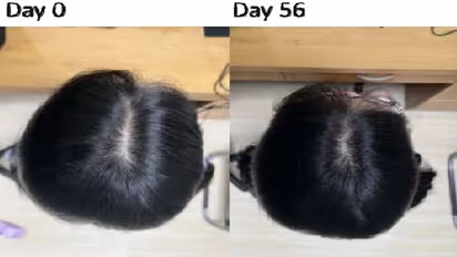 Hair Fall Treatment