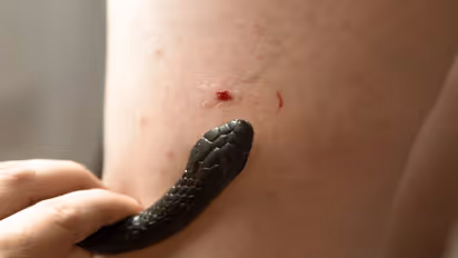 Snake Bite First Aid